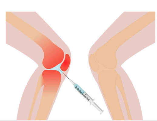 3ml Solusi Mesoterapi Nyeri Lutut Non Asam Hyaluronic Bertautan Silang