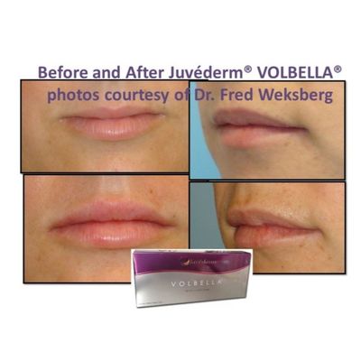 Asam Hyaluronic Juvederm Gel Penuh Wajah Kulit halus dan sempurna