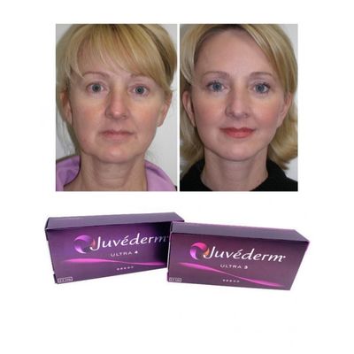 6-9 Bulan Durasi Juvederm Dermal Filler Gel Untuk Dibeli Online Dan Di Toko