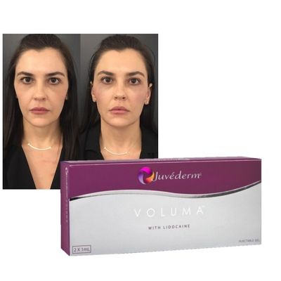 Gel Pengisi Dermal Asam Hyaluronic Juvederm Formula Peningkatan Peremajaan Bibir Pipi