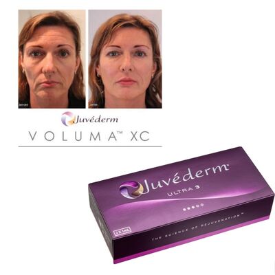 Koreksi Kerutan Juvederm Filler Kulit Asam Hyaluronic Gel Injeksi Perawatan Penghalusan Lama