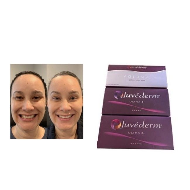 Pengisi Dermal Juvederm HA Silang Ultra3 Ultra4 Voluma Kondisi Penyimpanan Hindari Pembekuan Gel Injeksi untuk Restorasi Volume Wajah