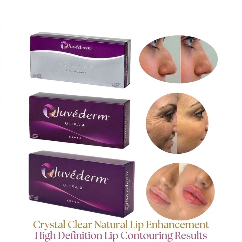 Volume Jarum Suntik 2 1Ml Per Kotak Juvederm Pengisi Voluma Pengisi Dermal Suntik Kontur Wajah Aman untuk Peningkatan Volume